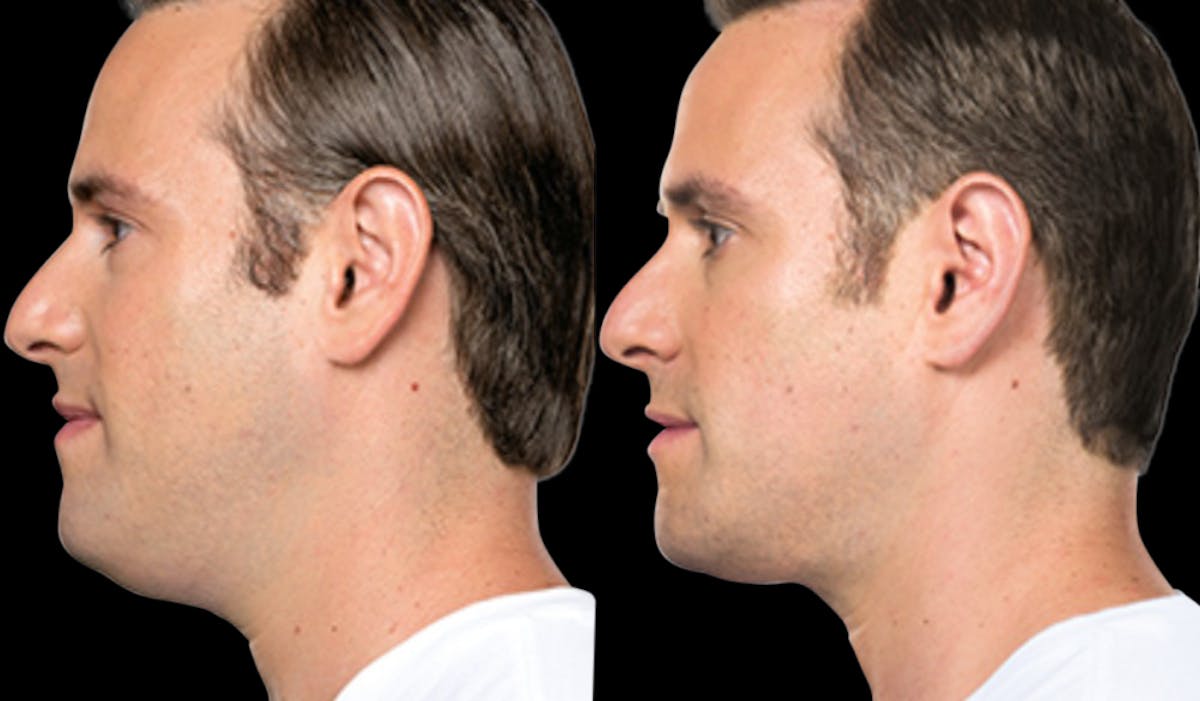 Lipo Dissolver - Kybella Before & After Gallery - Patient 240528 - Image 1