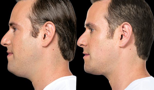 Lipo Dissolver - Kybella Before & After Gallery - Patient 240528 - Image 1