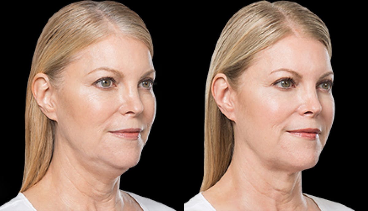 Lipo Dissolver - Kybella Before & After Gallery - Patient 322801 - Image 3