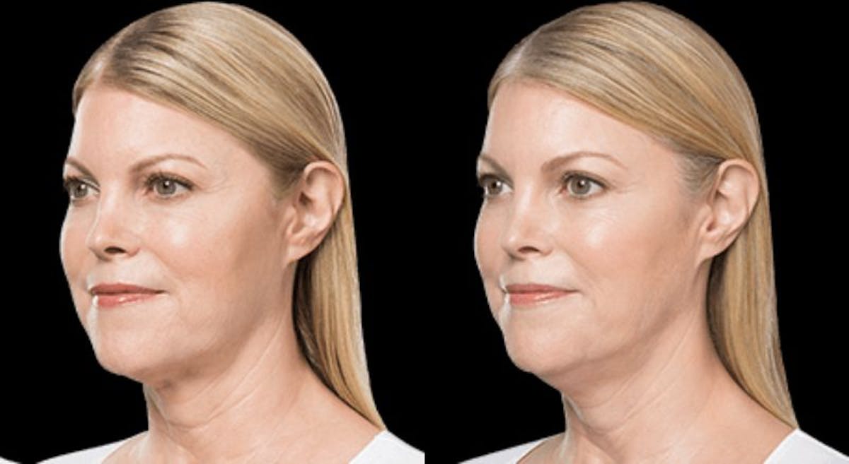 Lipo Dissolver - Kybella Before & After Gallery - Patient 322801 - Image 2