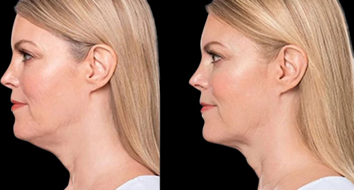 Lipo Dissolver - Kybella Before & After Gallery - Patient 322801 - Image 1