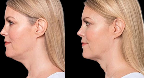 Lipo Dissolver - Kybella Before & After Gallery - Patient 322801 - Image 1