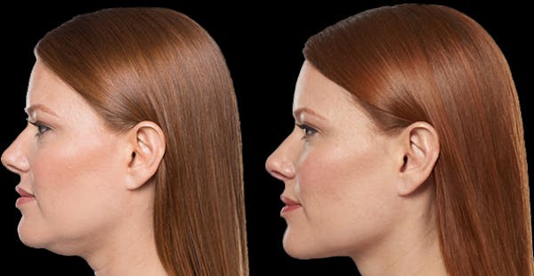 Lipo Dissolver - Kybella Before & After Gallery - Patient 235902 - Image 1