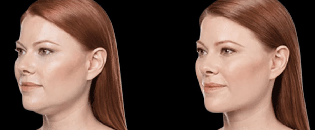 Lipo Dissolver - Kybella Before & After Gallery - Patient 235902 - Image 2