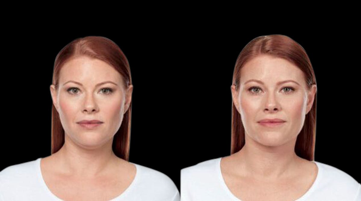 Lipo Dissolver - Kybella Before & After Gallery - Patient 235902 - Image 3