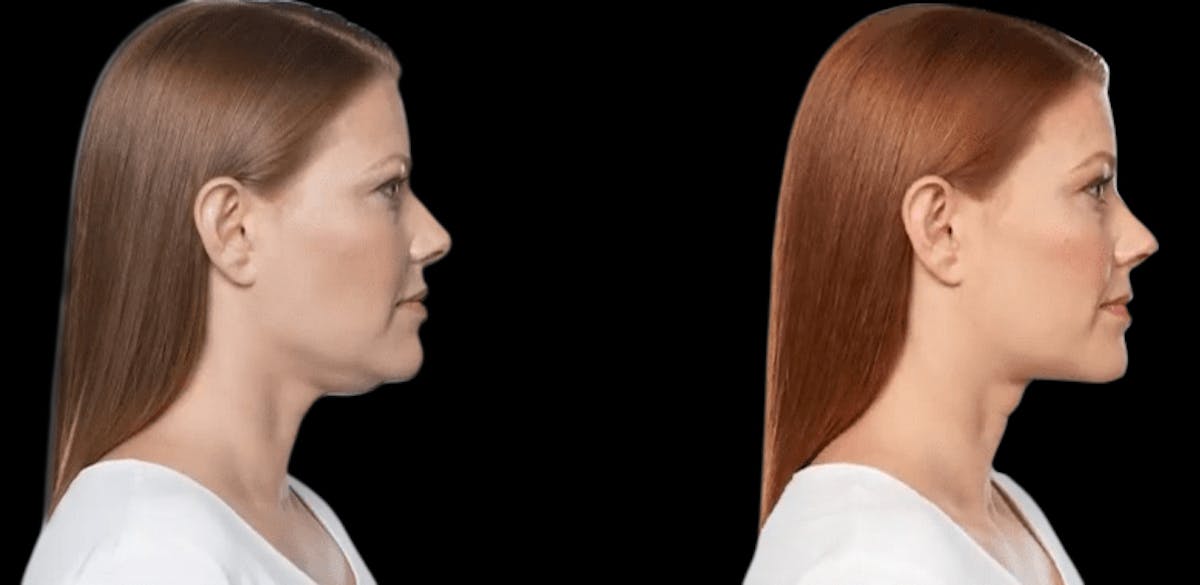 Lipo Dissolver - Kybella Before & After Gallery - Patient 235902 - Image 4