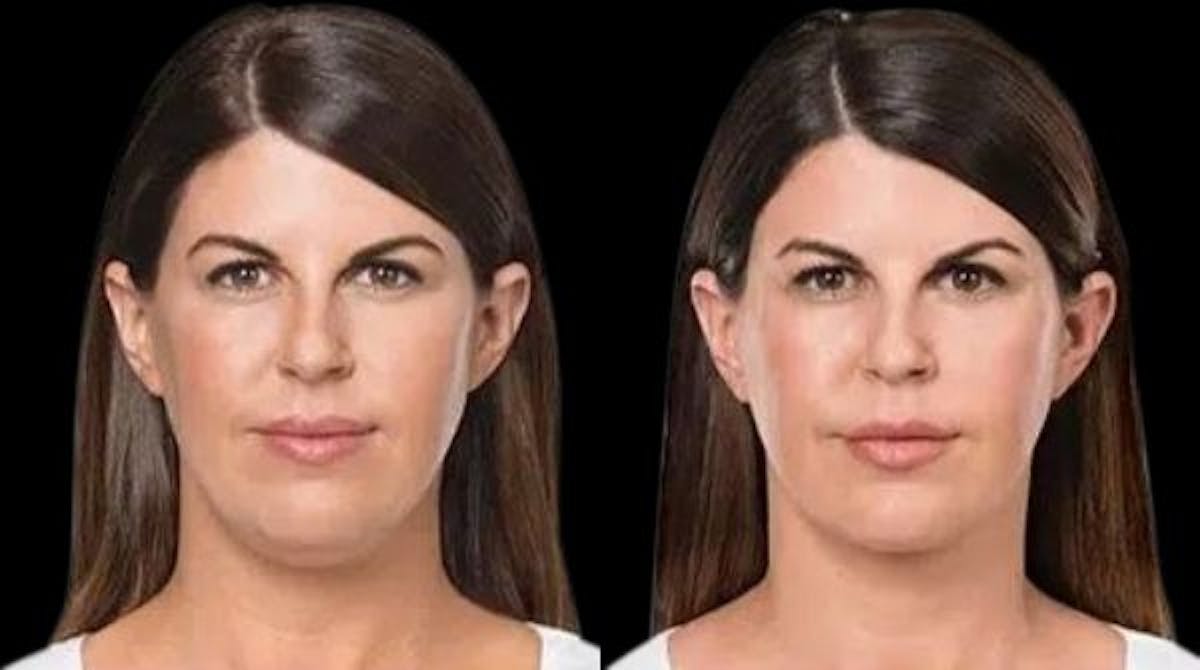 Lipo Dissolver - Kybella Before & After Gallery - Patient 323185 - Image 2