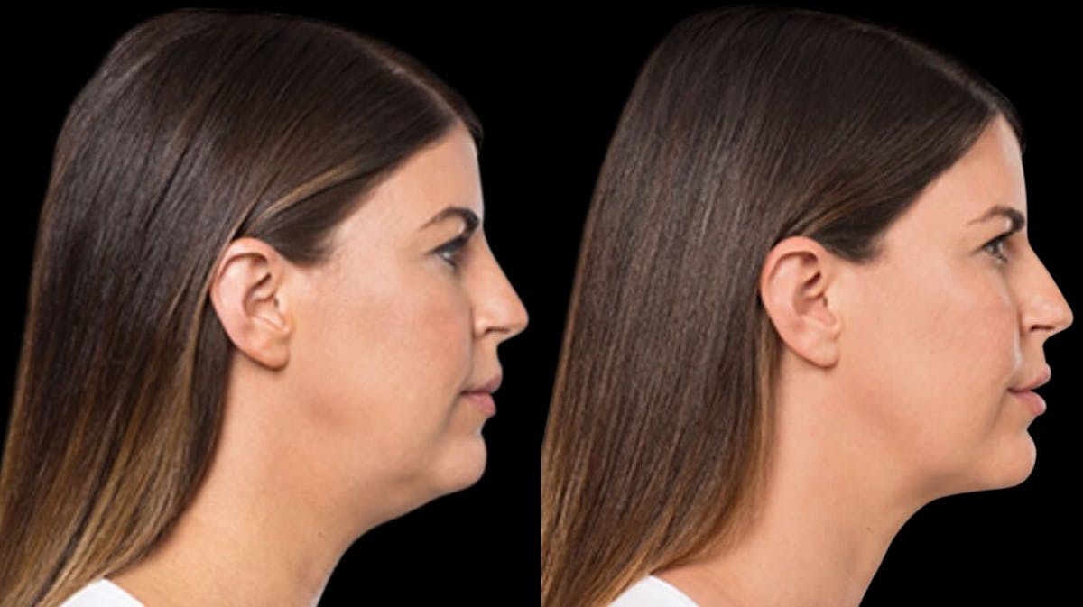 Lipo Dissolver - Kybella Before & After Gallery - Patient 323185 - Image 3