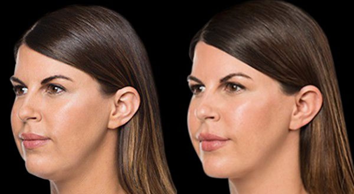 Lipo Dissolver - Kybella Before & After Gallery - Patient 323185 - Image 4
