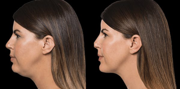 Lipo Dissolver - Kybella Before & After Gallery - Patient 323185 - Image 1