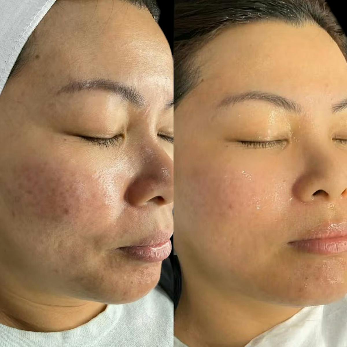 Microneedling Before & After Gallery - Patient 439355 - Image 1