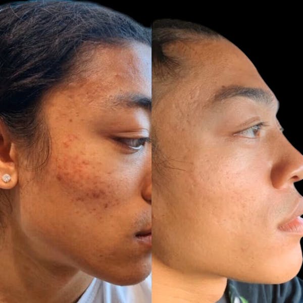 Microneedling Before & After Gallery - Patient 156609 - Image 1