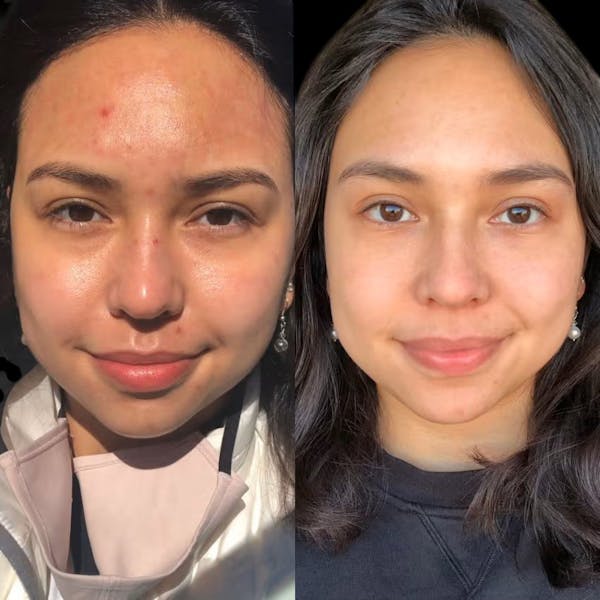 Microneedling Before & After Gallery - Patient 245972 - Image 1