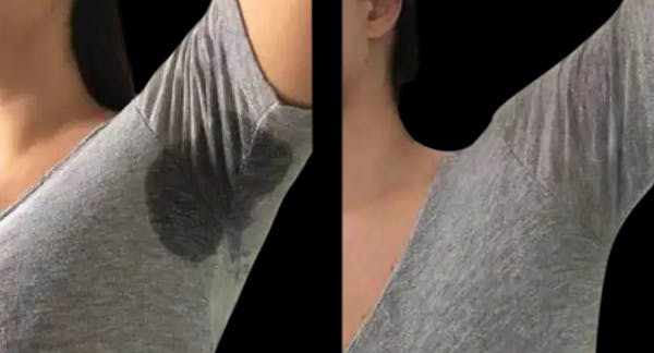 miraDry® Before & After Gallery - Patient 288221 - Image 1