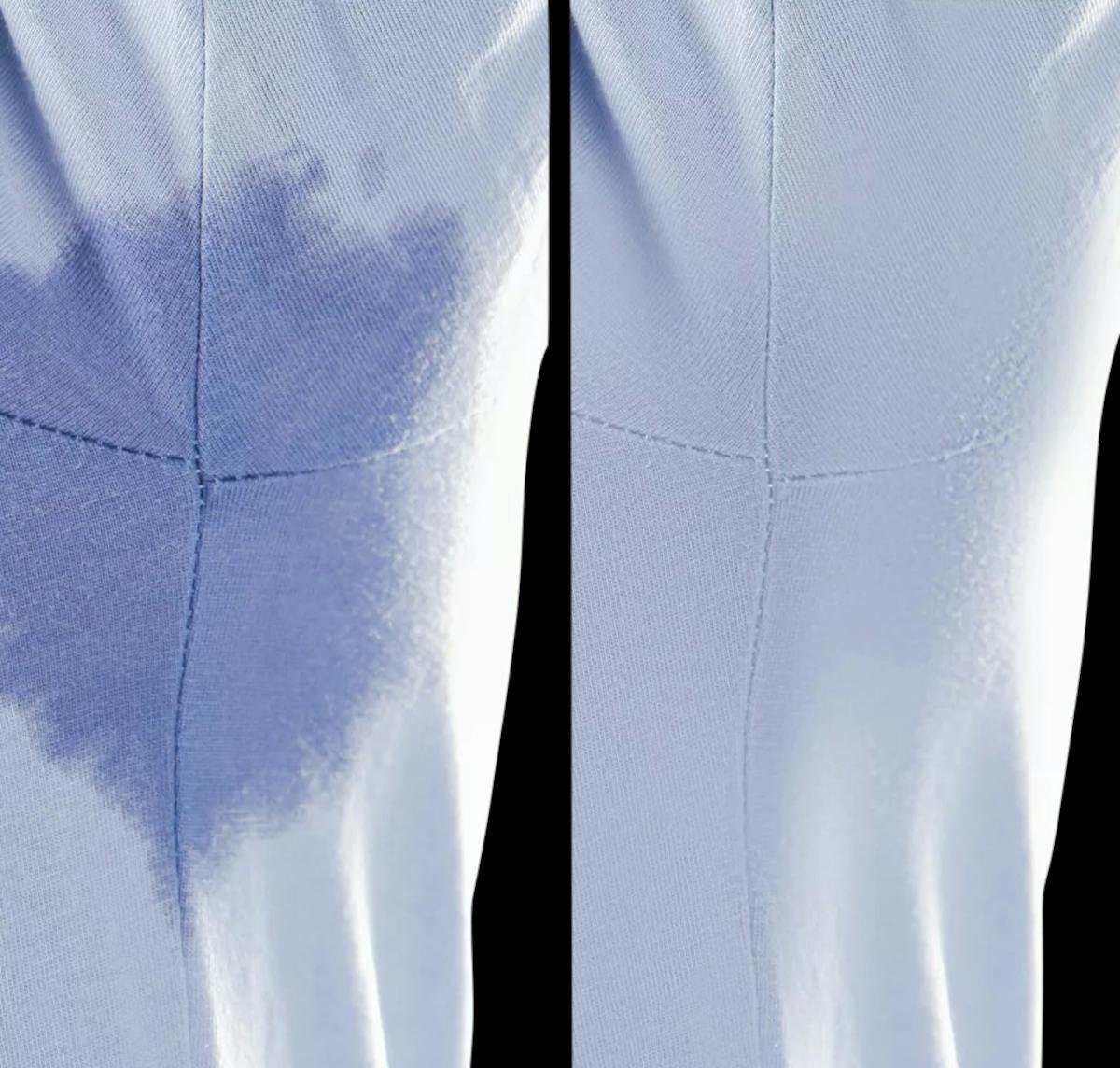miraDry® Before & After Gallery - Patient 280604 - Image 1