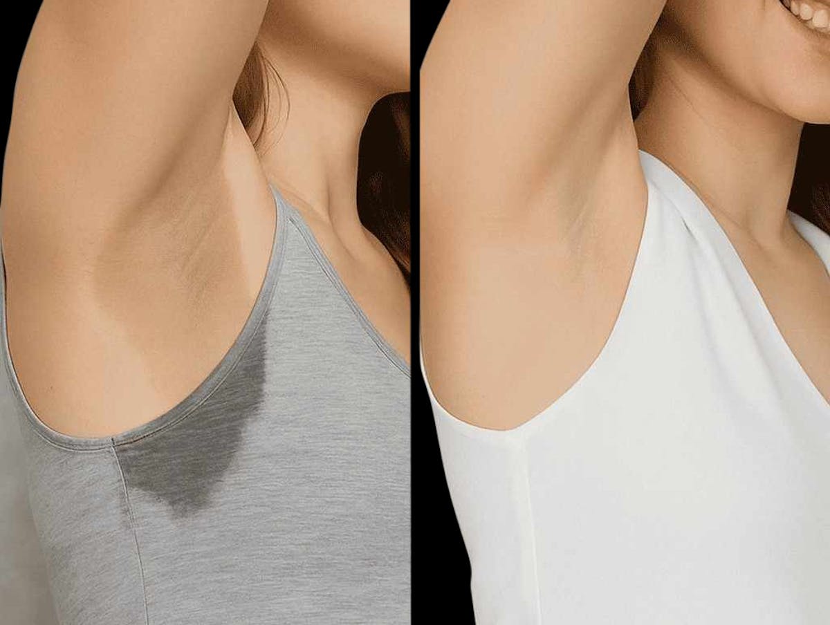 miraDry® Before & After Gallery - Patient 250203 - Image 1