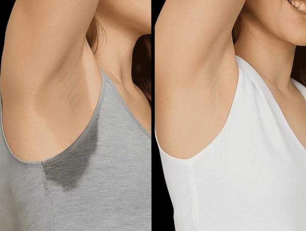 miraDry® Before & After Gallery - Patient 250203 - Image 1