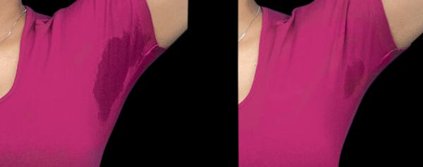 miraDry® Before & After Gallery - Patient 359126 - Image 1