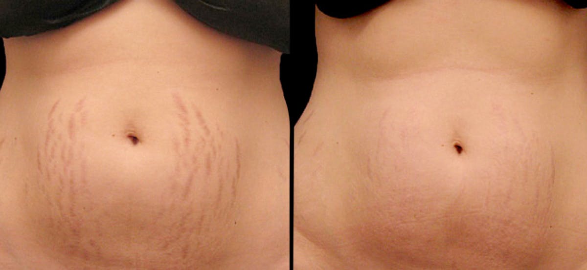 Procell Therapies Before & After Gallery - Patient 137214 - Image 1