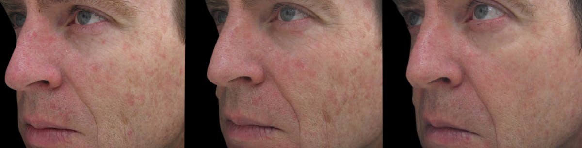 Procell Therapies Before & After Gallery - Patient 416251 - Image 1