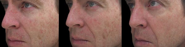 Procell Therapies Before & After Gallery - Patient 416251 - Image 1
