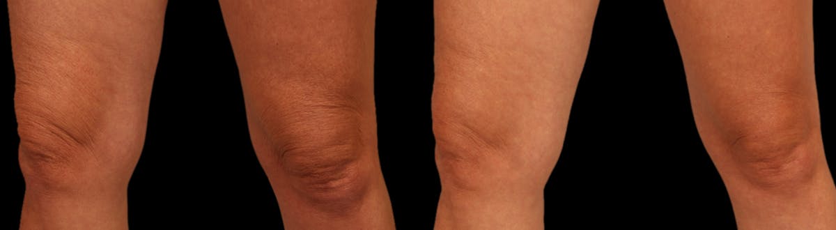 Procell Therapies Before & After Gallery - Patient 222328 - Image 1