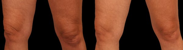 Procell Therapies Before & After Gallery - Patient 222328 - Image 1