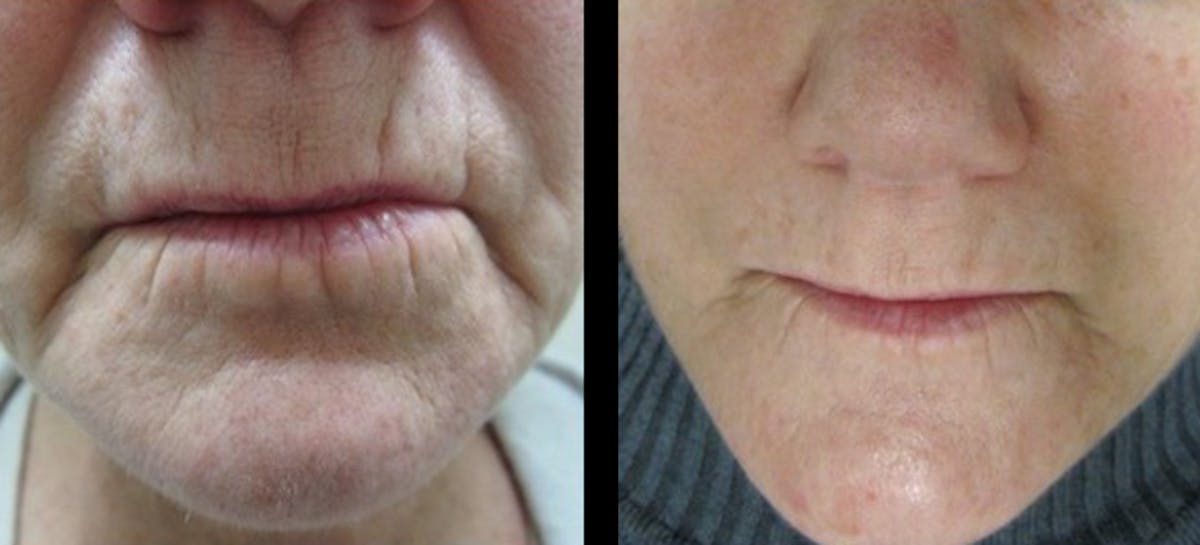 Procell Therapies Before & After Gallery - Patient 347365 - Image 1