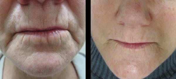 Procell Therapies Before & After Gallery - Patient 347365 - Image 1