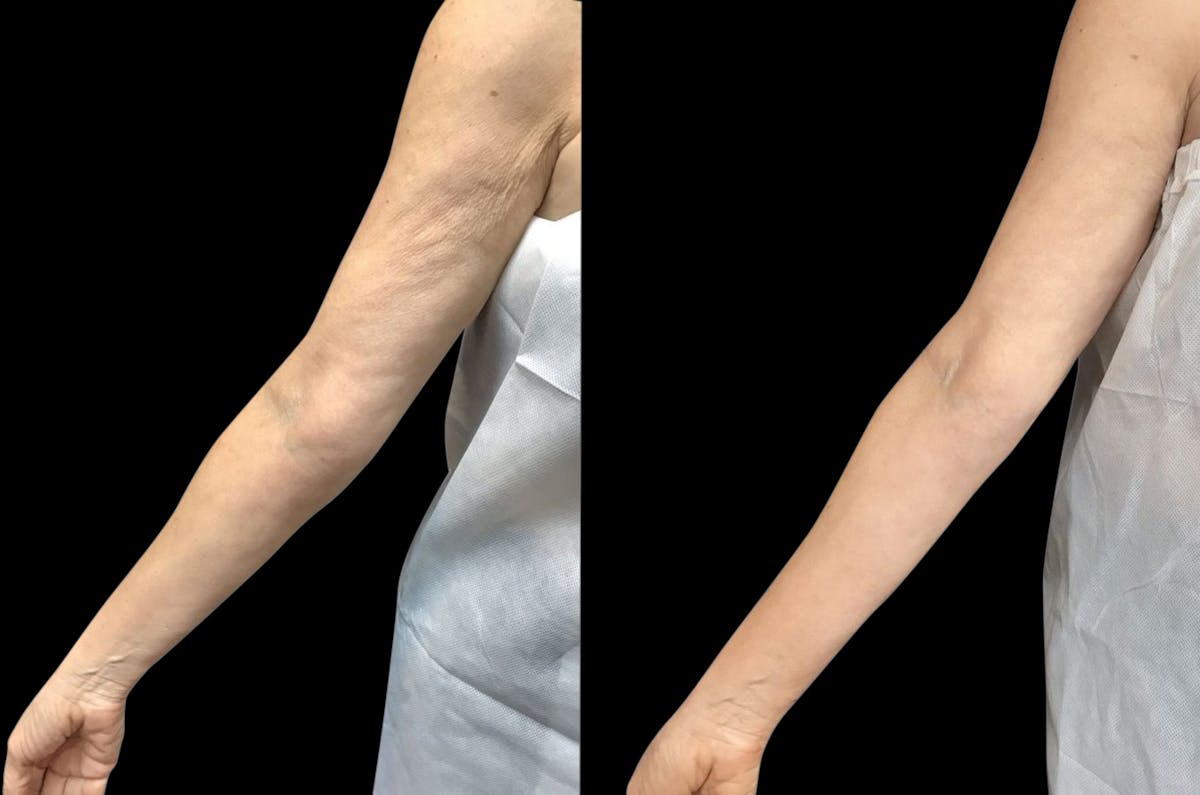 Procell Therapies Before & After Gallery - Patient 347563 - Image 1