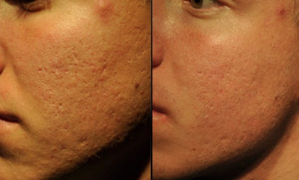 Procell Therapies Before & After Gallery - Patient 117460 - Image 1