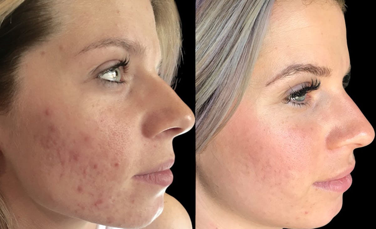 Procell Therapies Before & After Gallery - Patient 393290 - Image 1