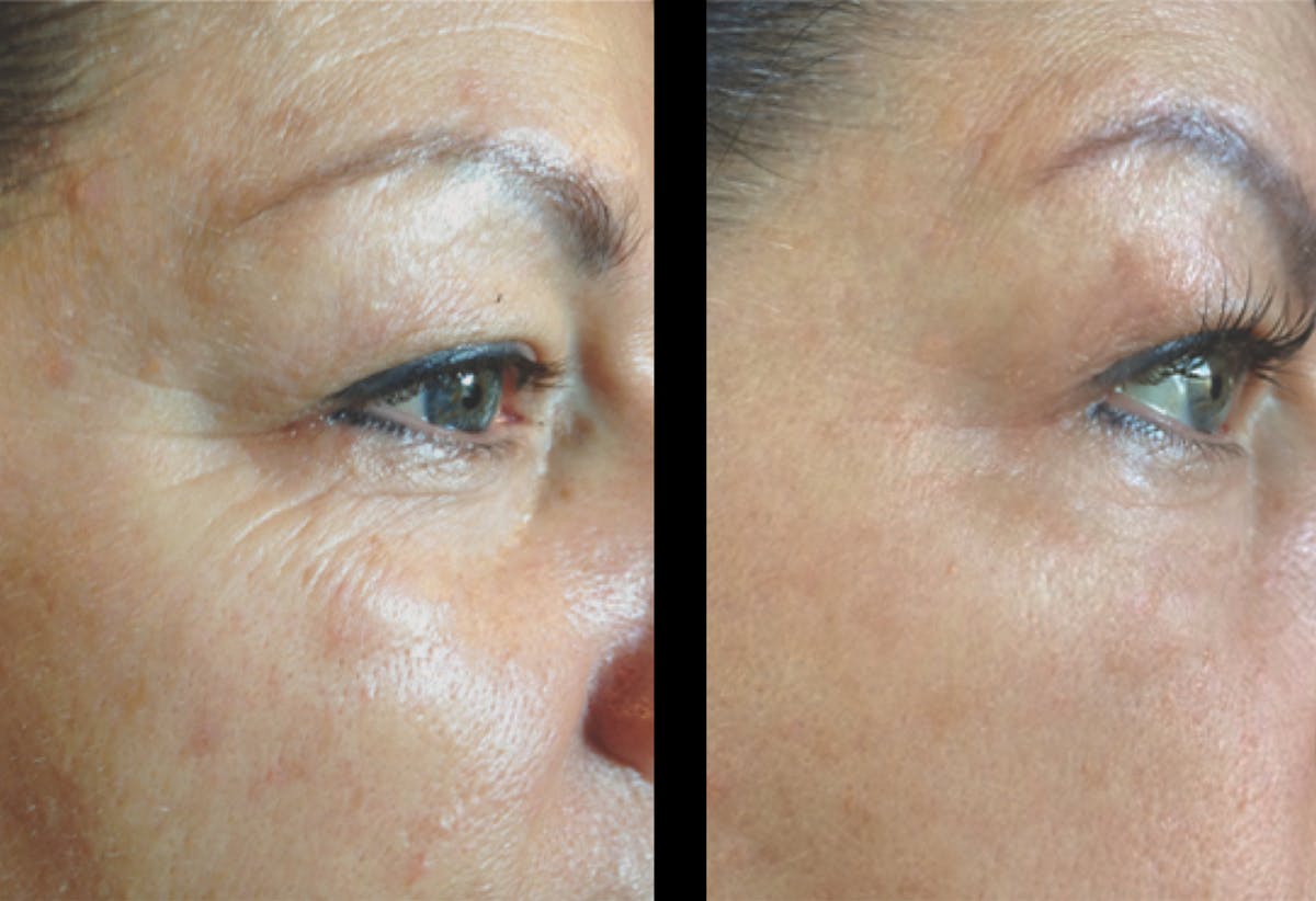 Procell Therapies Before & After Gallery - Patient 296304 - Image 1