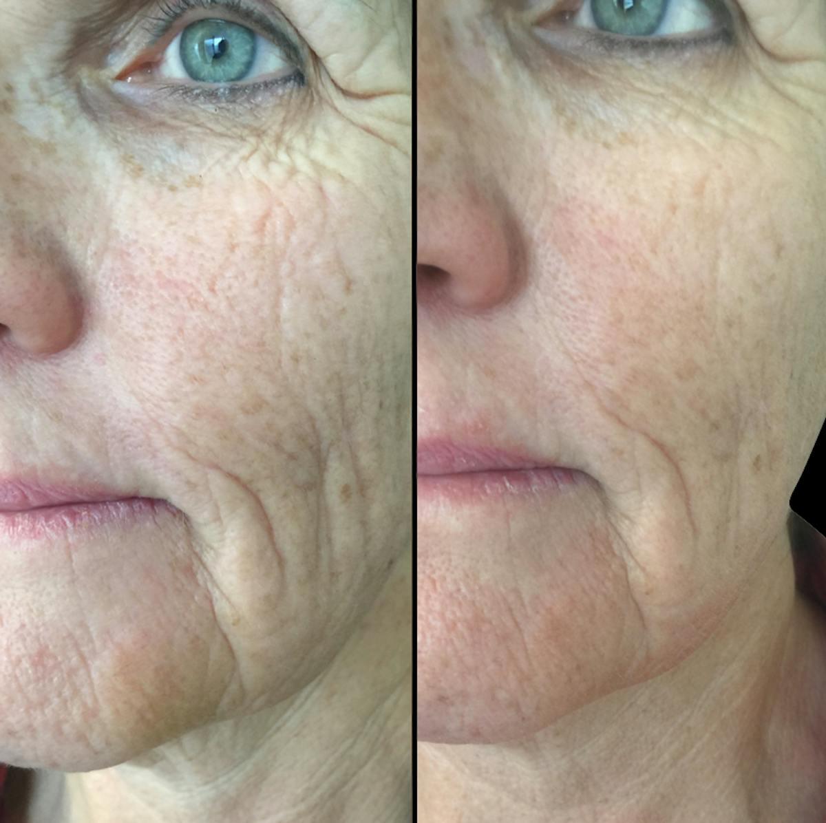 Procell Therapies Before & After Gallery - Patient 400174 - Image 1