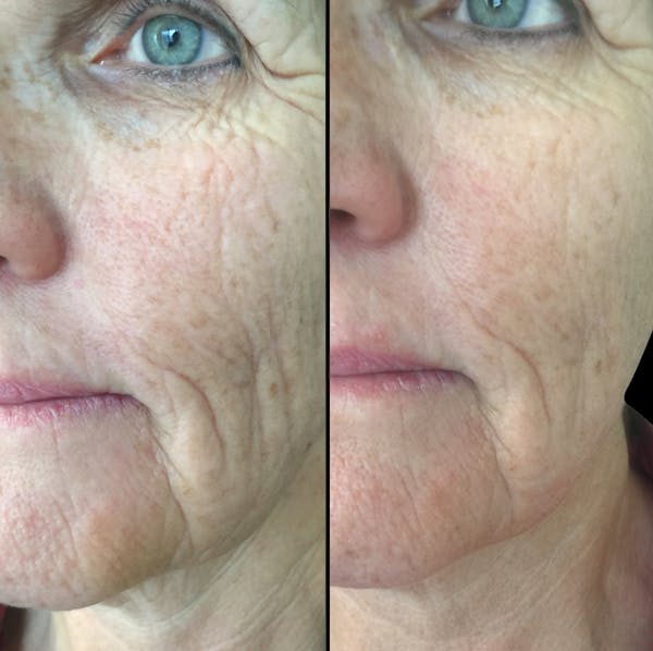 Procell Therapies Before & After Gallery - Patient 400174 - Image 1