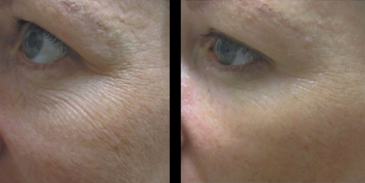 Procell Therapies Before & After Gallery - Patient 277779 - Image 1