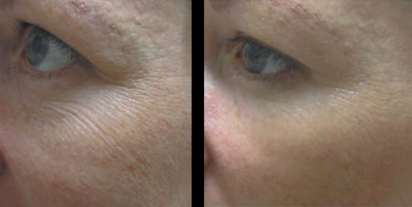 Procell Therapies Before & After Gallery - Patient 277779 - Image 1