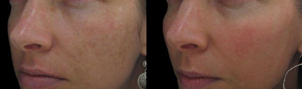 Procell Therapies Before & After Gallery - Patient 436974 - Image 1