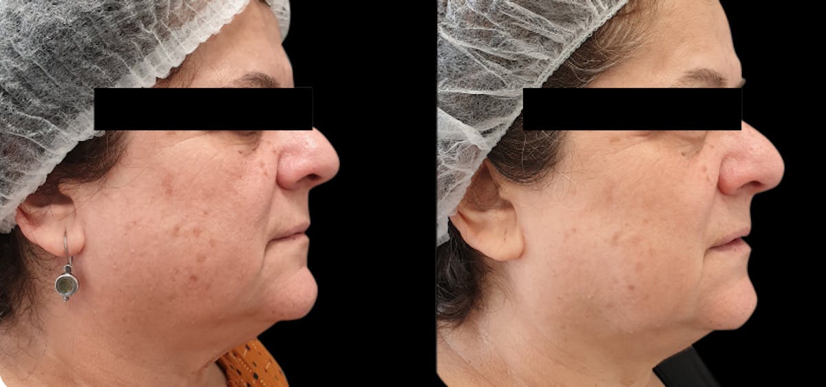 Tribella Before & After Gallery - Patient 157419 - Image 1