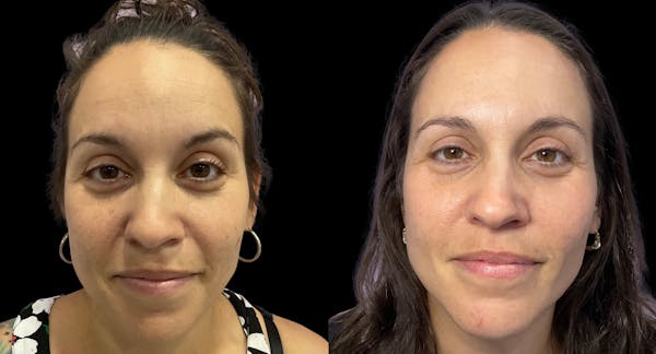 Tribella Before & After Gallery - Patient 147474 - Image 1