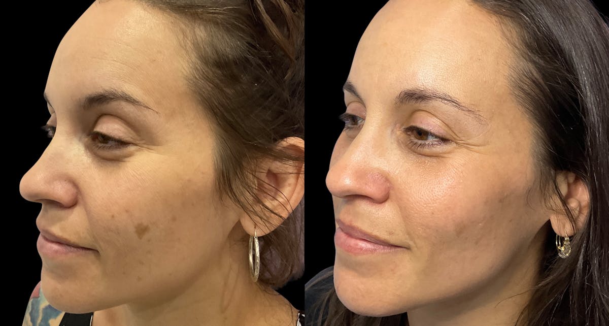 Tribella Before & After Gallery - Patient 147474 - Image 2