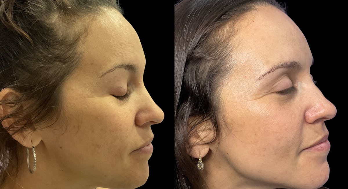Tribella Before & After Gallery - Patient 147474 - Image 3