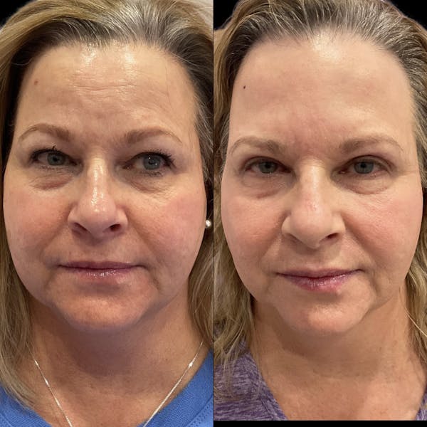 Tribella Before & After Gallery - Patient 225885 - Image 1