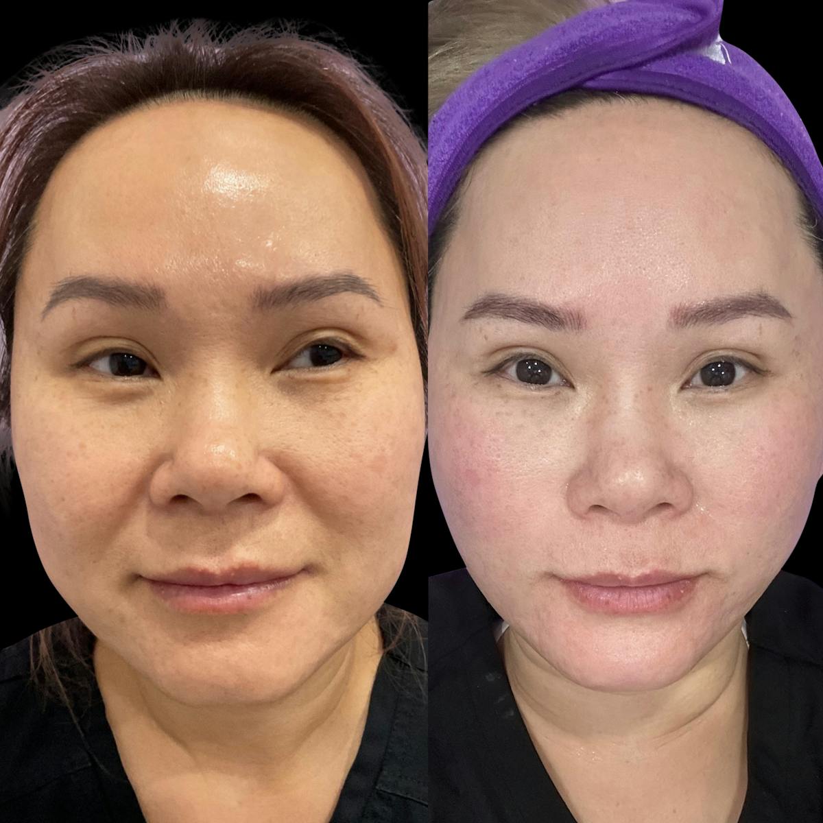 Tribella Before & After Gallery - Patient 221329 - Image 1