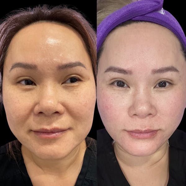 Tribella Before & After Gallery - Patient 221329 - Image 1