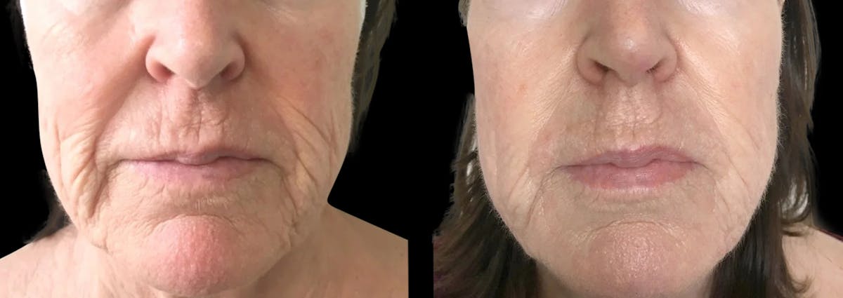 Tribella Before & After Gallery - Patient 257996 - Image 1