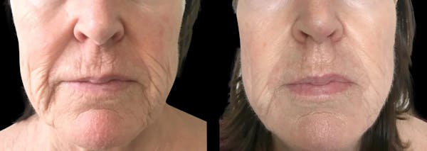 Tribella Before & After Gallery - Patient 257996 - Image 1