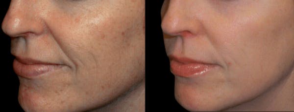 Tribella Before & After Gallery - Patient 229350 - Image 1