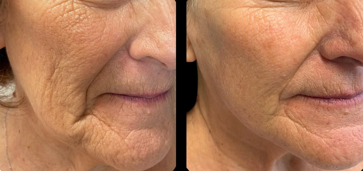 Tribella Before & After Gallery - Patient 408704 - Image 1