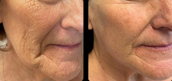 Tribella Before & After Gallery - Patient 408704 - Image 1